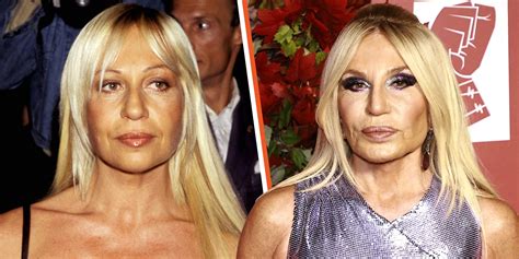 donatella versace facelift.